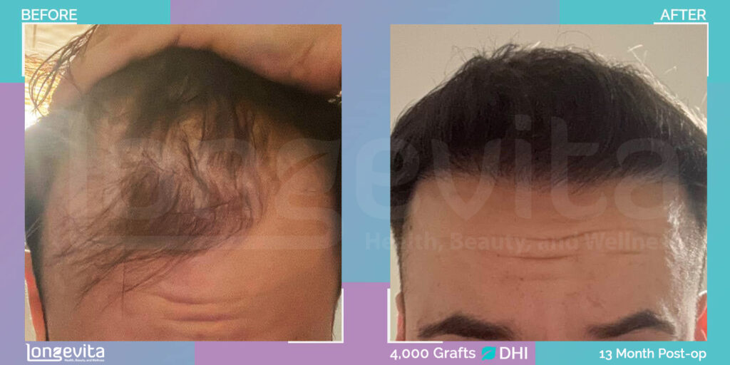 DHI Hair Transplant Before and After Results After 13 Months 4000 Grafts