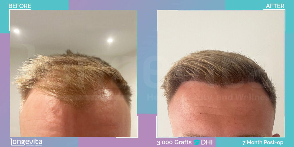 DHI Hair Transplant Before and After Image - 23 year old male, 3000 grafts, 7 months recovery stage