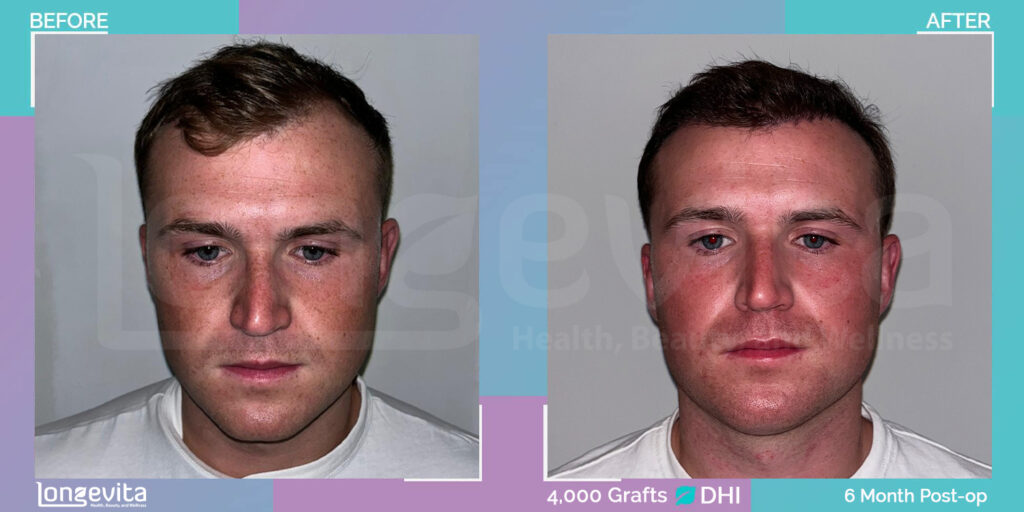 DHI Hair Transplant Patient, surgery by Dr Cagla, 6 month recovery images before and after