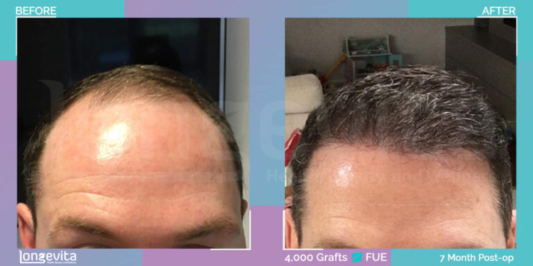 4000 Grafts FUE Hair Transplant Before and After Results After 7 Months