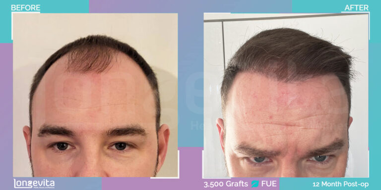 Male FUE 3,500 graft Hair transplant turkey Before After