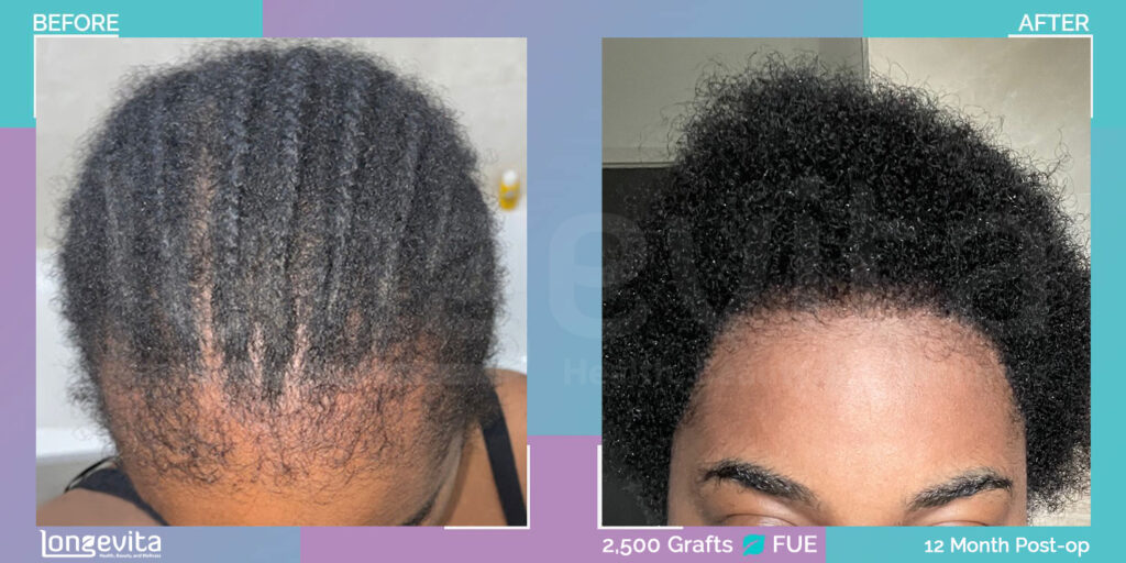FUE Hair Transplant Before and After Image by Dr Cagla