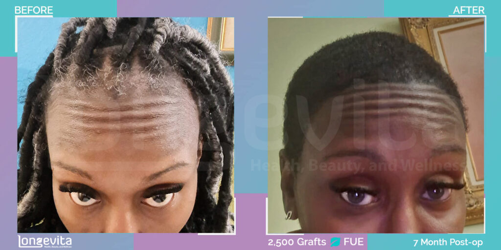 afro woman hair transplant 7 months recovery