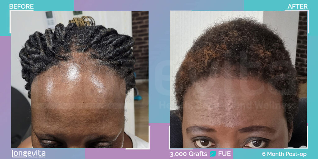 afro female hair transplant before and after