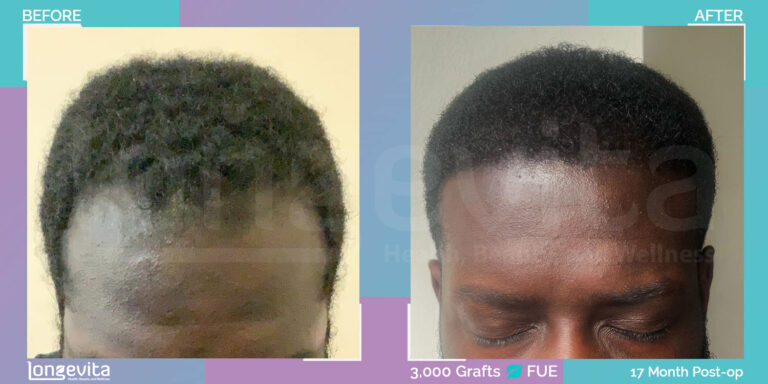 Afro Male 3000 Graft FUE Hair Transplant Before and After Images