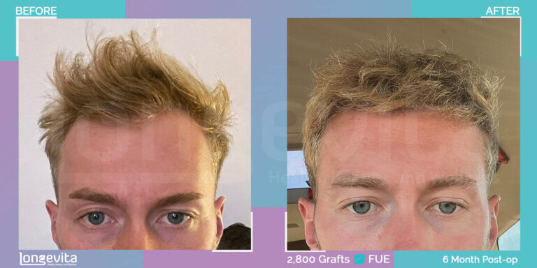 2,800 Graft FUE Hair Transplant on 26 Year Old Male - Before and After Images