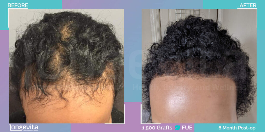 afro female hair transplant results 6 months