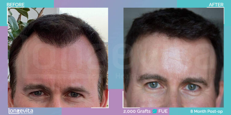 FUE Hair Transplant Before and After Images - 2000 Grafts, 8 Month Recovery