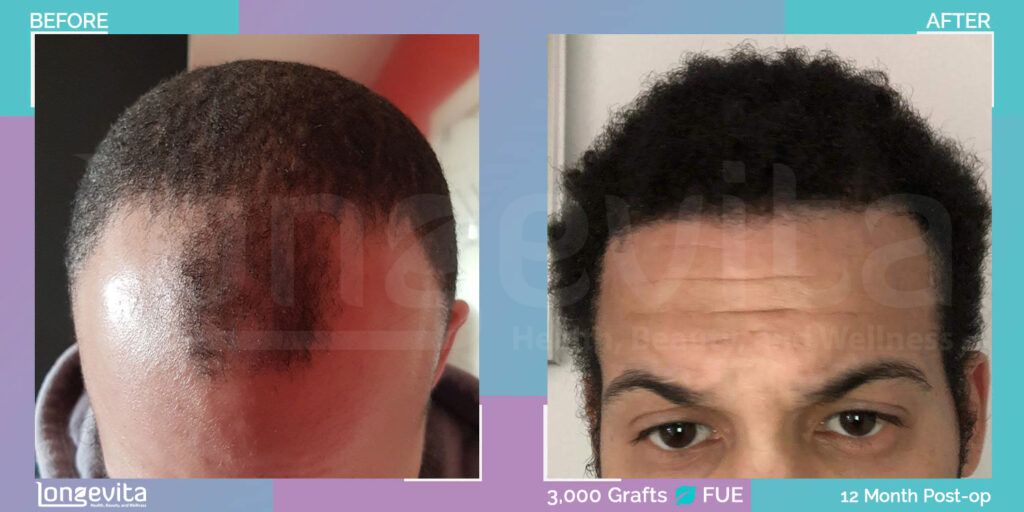 afro hair loss before and after