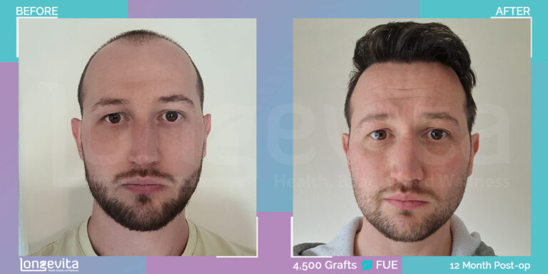 12 Month FUE Hair Transplant Results 4500 Grafts Before and After