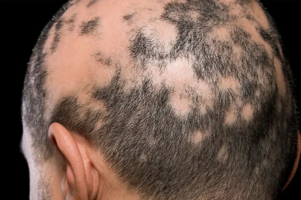 back of a man's scalp showing patchy hair loss typical of central centrifugal cicatricial alopecia