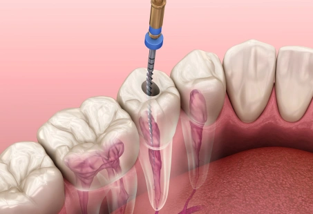 root canal treatment.webp