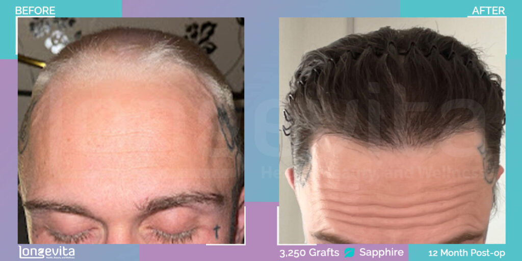 Sapphire FUE Hair Transplant patient, Surgery by Dr Cagla, Longevita - Before and After Image