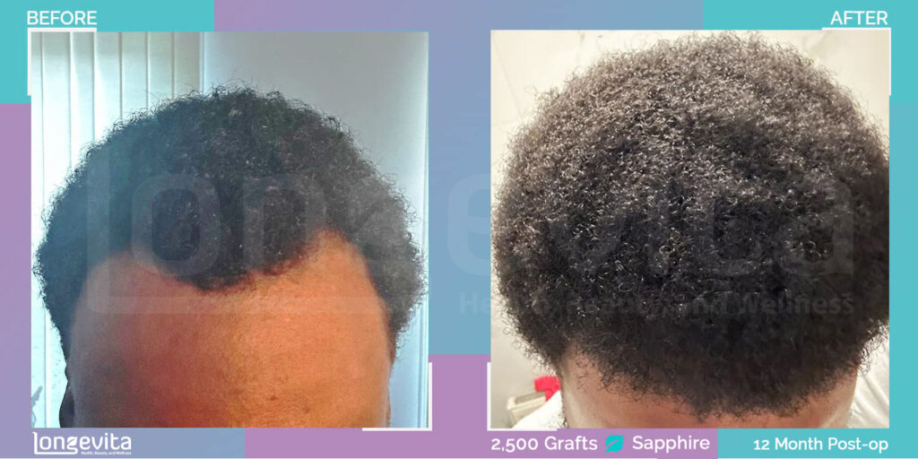 afro hair loss before and after