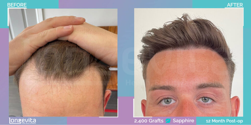 male sapphire fue hair transplant results 12 months later