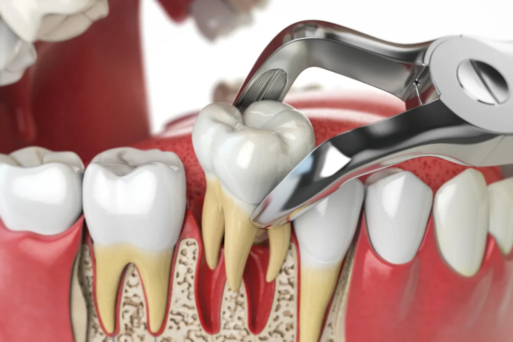 tooth extraction scaled.webp