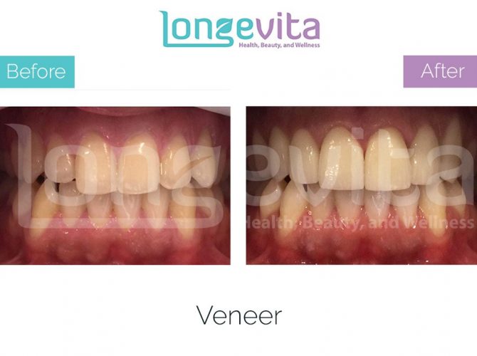 veneer turkey before after 1 670x500 1.jpg