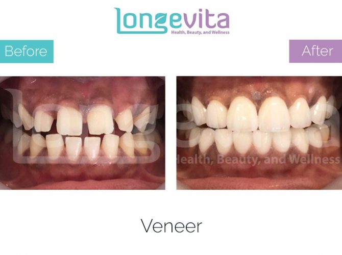 veneer turkey before after 2 670x500 1.jpg
