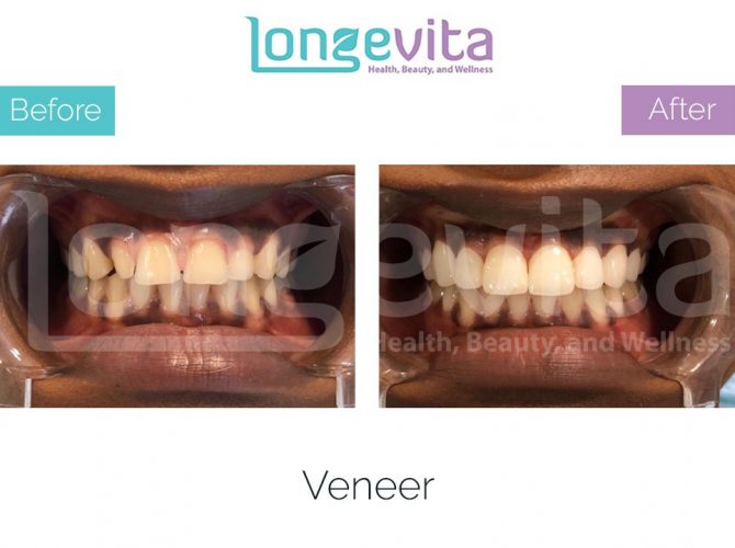 veneer turkey before after 3 670x500 1.jpg