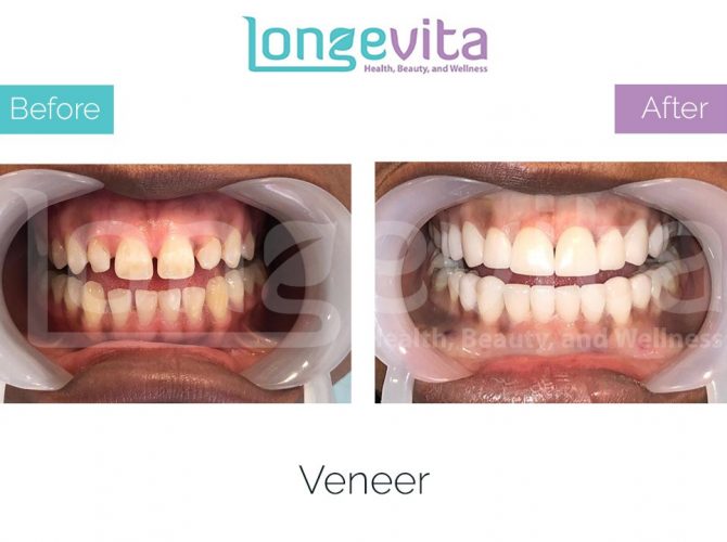 veneer turkey before after 4 670x500 1.jpg