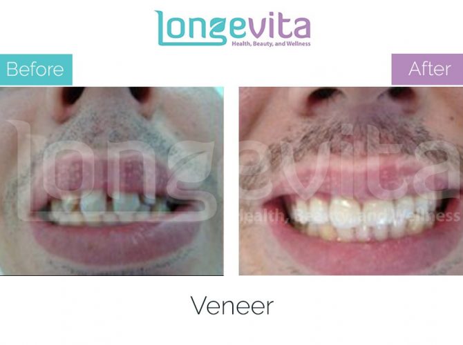 veneer turkey before after 5 670x500 1.jpg