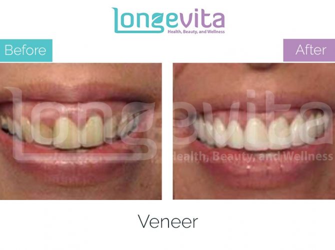 veneer turkey before after 6 670x500 1.jpg