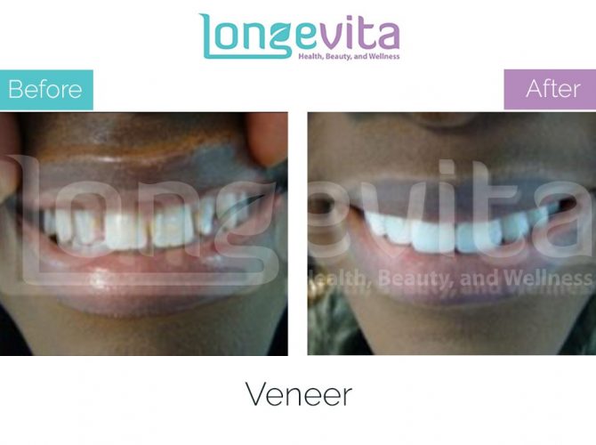 veneer turkey before after 7 670x500 1.jpg
