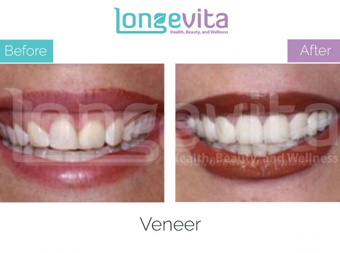 veneer turkey before after 8 670x500 1.jpg