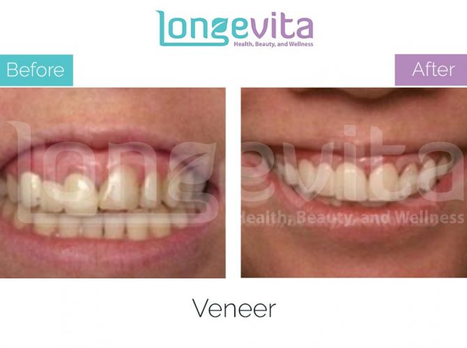 veneer turkey before after 9 670x500 1.jpg