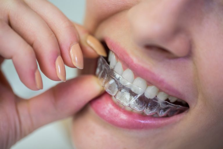 woman wearing orthodontic silicone invisible braces 768x512 1.jpg