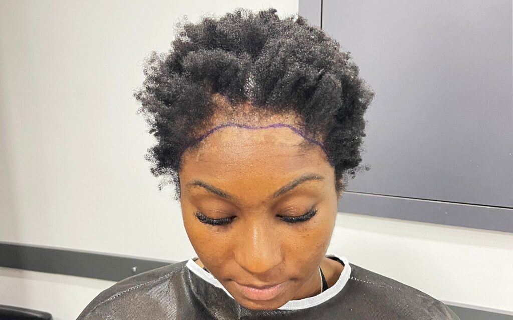 female hair transplant prep