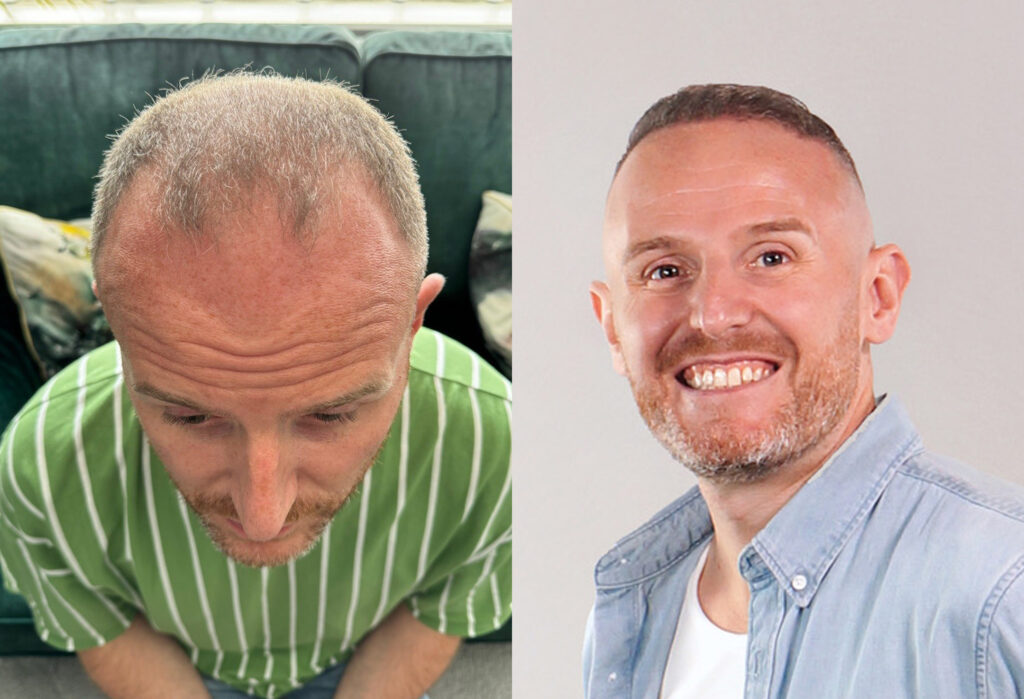 Glenn Hair Transplant BeforeAfter