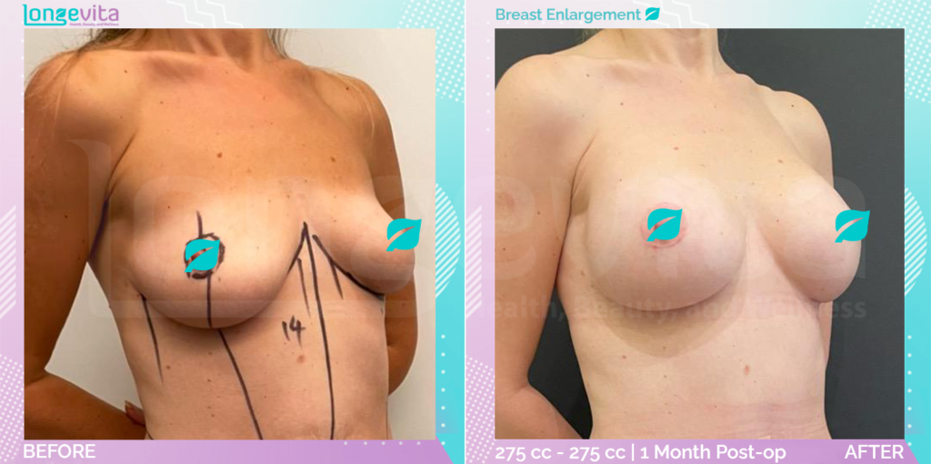 Dr Ercan Breast Enlargement