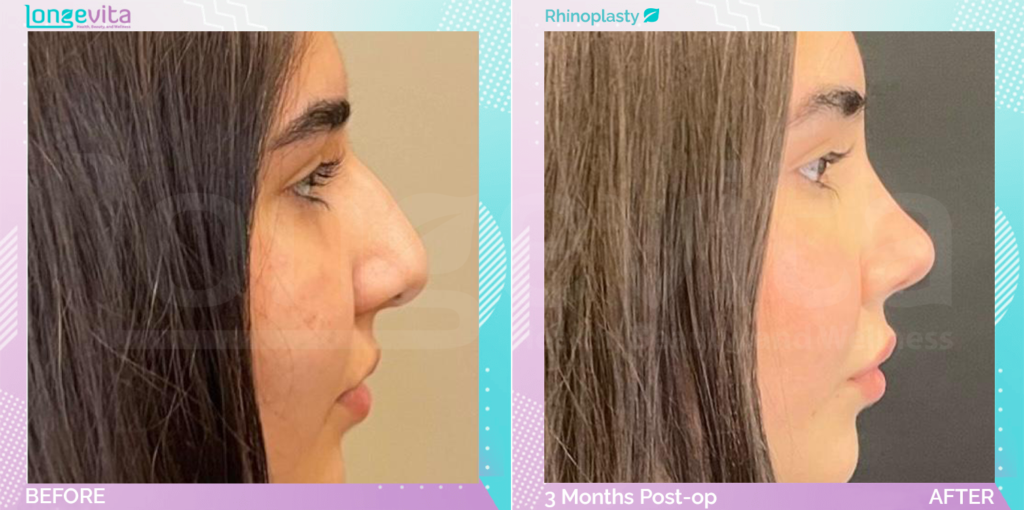 Dr Ercan Nose Job 1