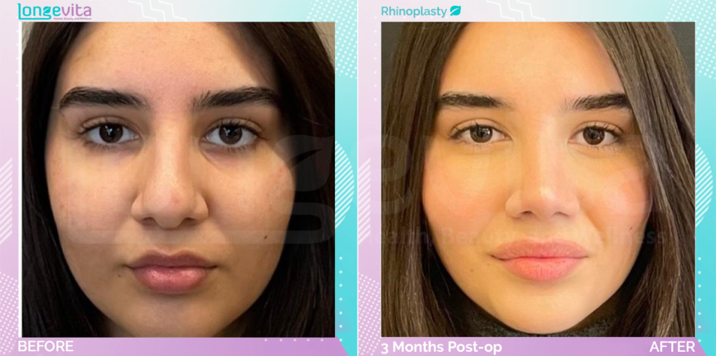 Dr Ercan Nose Job 2