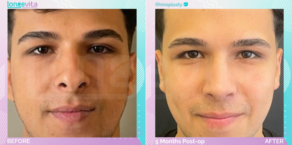 Dr Ercan Nose Job 4