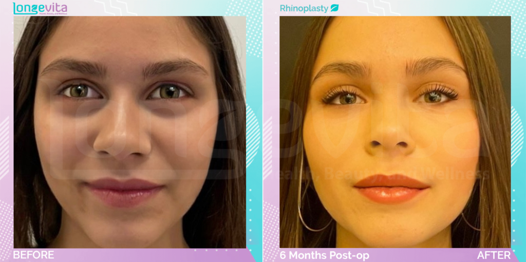Dr Ercan Nose Job 6