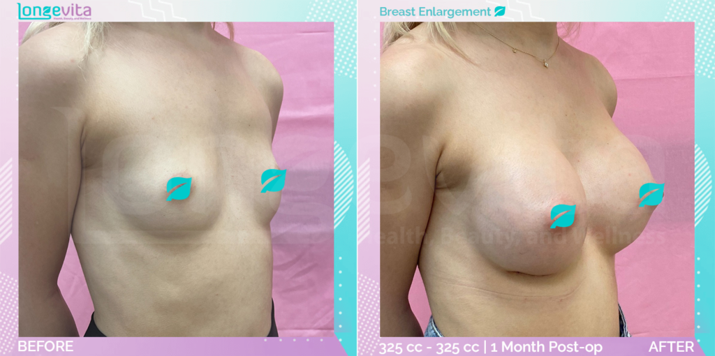 Dr Suheda Breast B&A 1