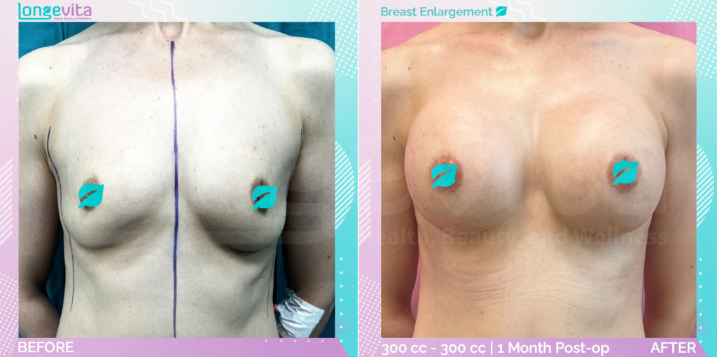 Dr Suheda Breast B&A 2