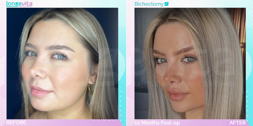 Dr Suheda Facial B&A 2
