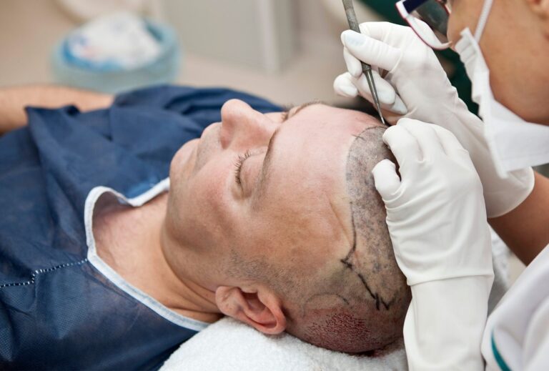 fue hair transplant uk