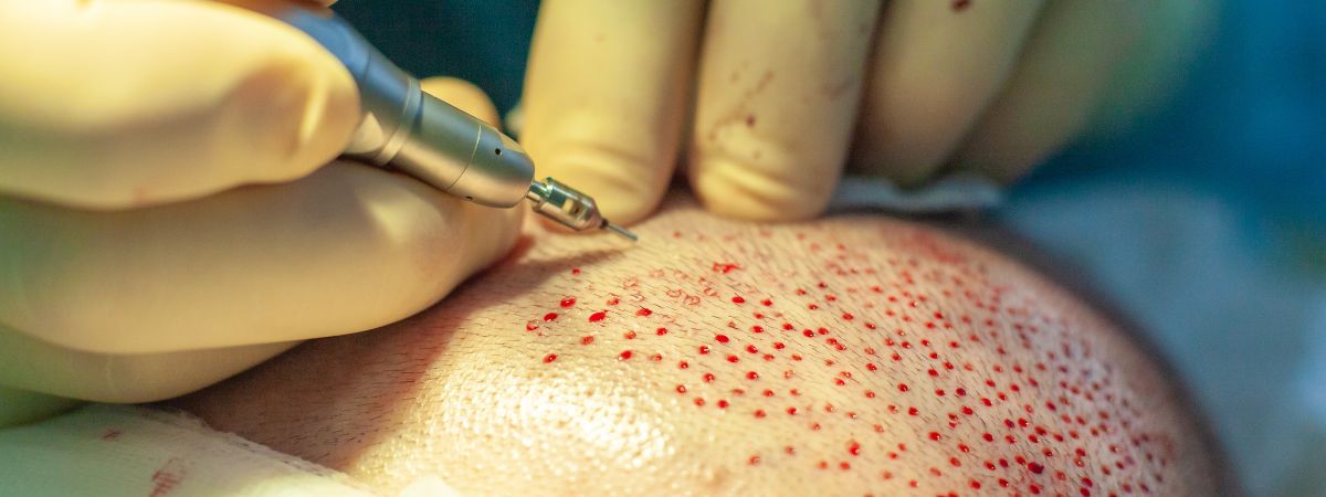hair transplant uk graft incision