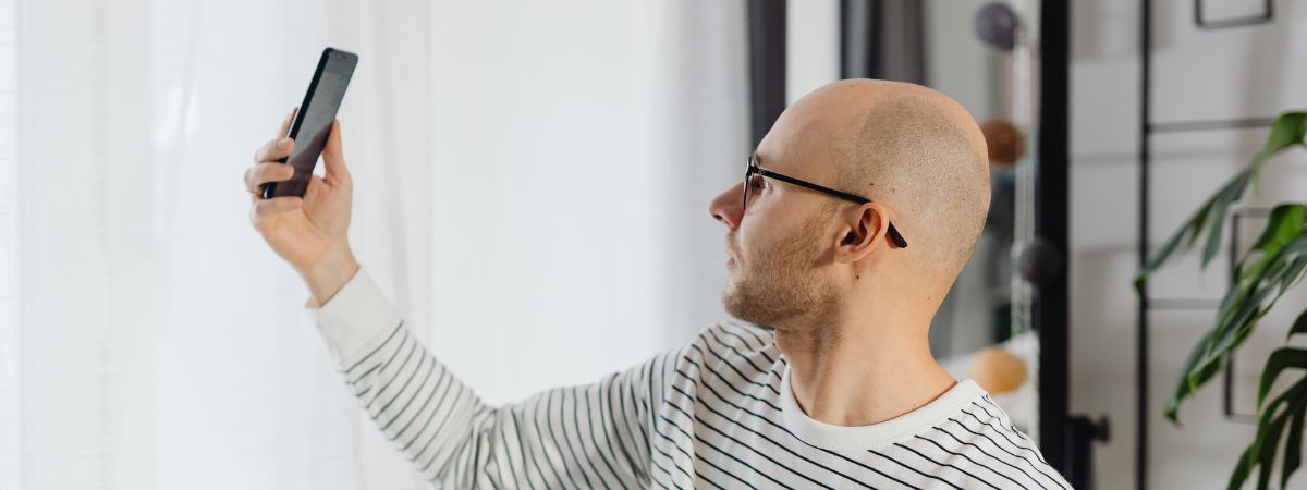 share your scalp photos for hair transplant uk