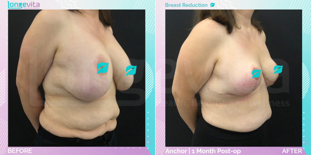 Dr Ekrem Breast reduction Patient 1