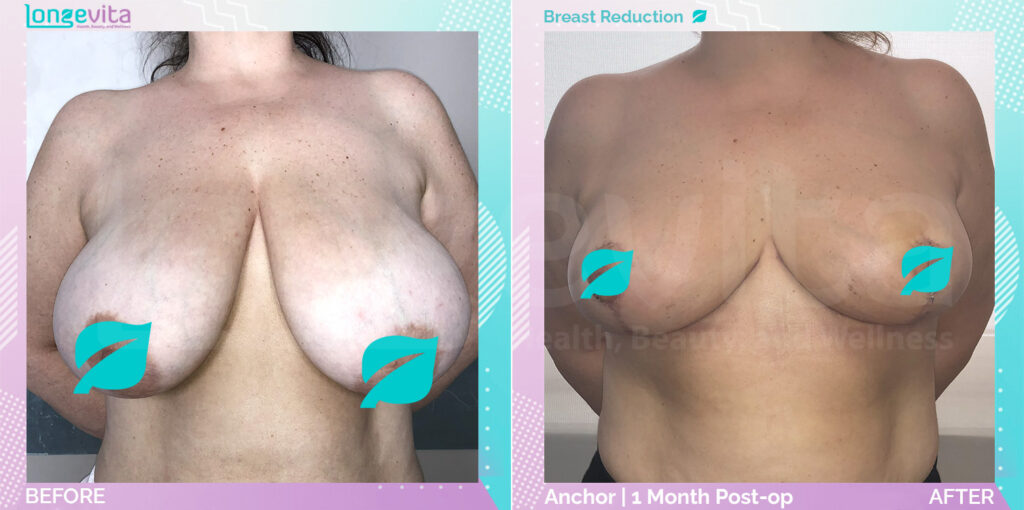 Dr Ekrem breast reduction Patient 3 before and after pictures