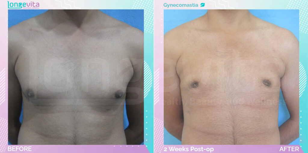 Dr Ekrem Gynecomastia Patient 10