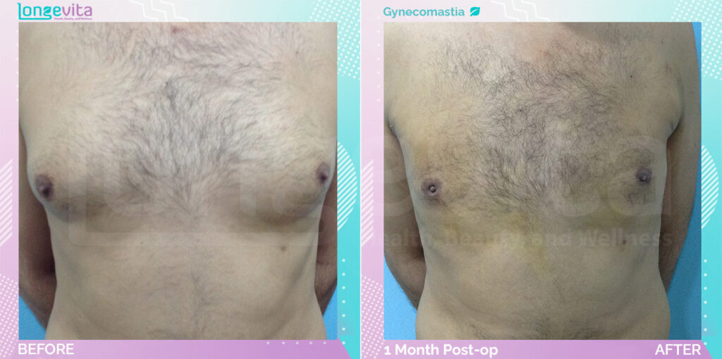 Dr Ekrem Gynecomastia Patient 5