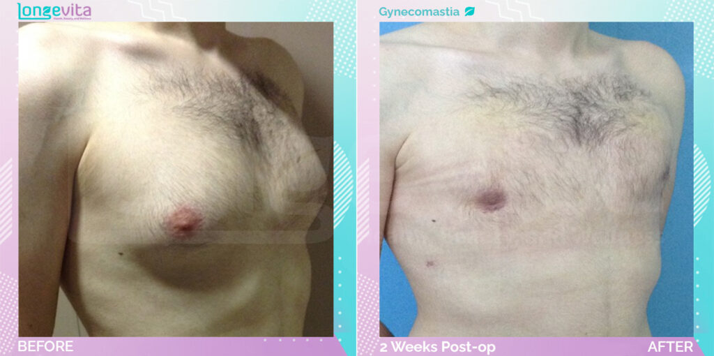 Dr Ekrem Gynecomastia Patient 9