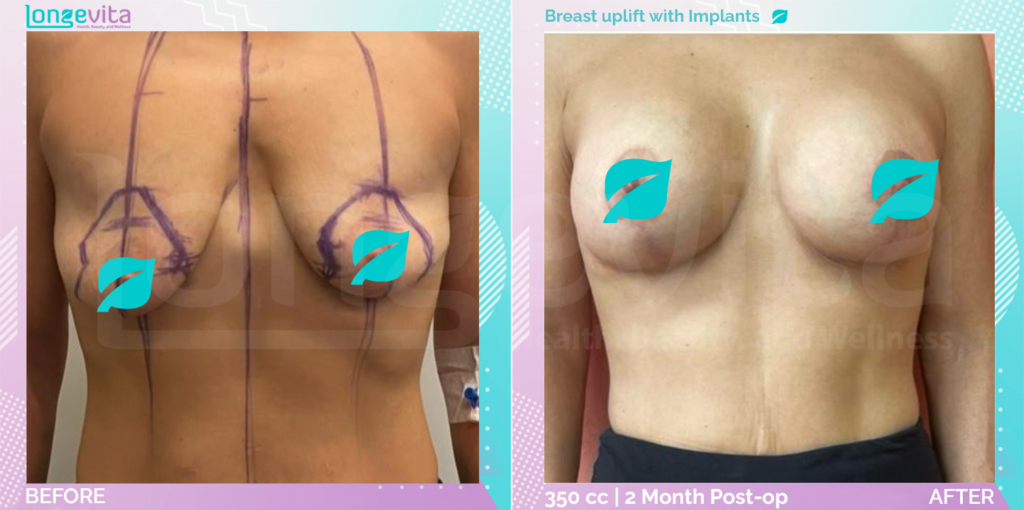 Dr Ercan Breast Uplift with Implants before after picture 2