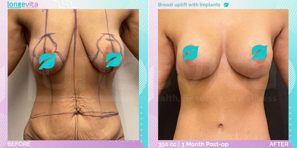 Dr Ercan Breast Uplift with Implants before after pictures 3